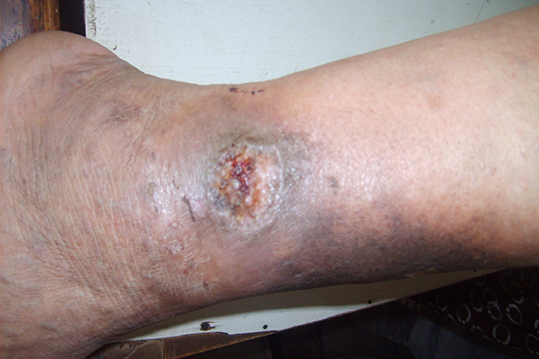 吉林治疗瘢痕.皮肤伤口医院