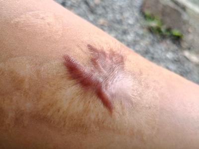 烧伤瘢痕如何治疗 三个方法治疗烧伤瘢痕
